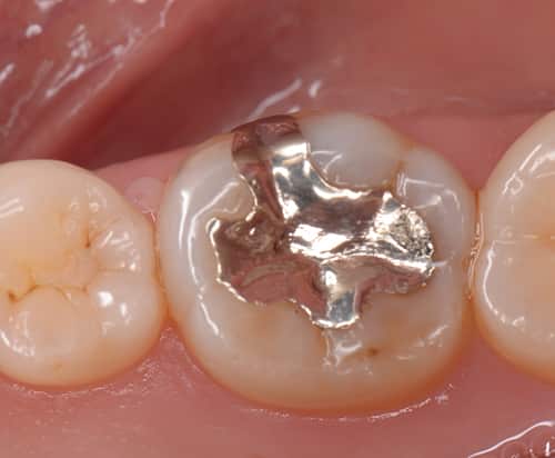 30代女性 銀歯をダイレクトボンディングで白く治療した症例 相模原市西橋本の歯医者さん ナチュラルデンタルオフィス橋本