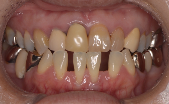 30代女性 前歯に隙間があり歯を削らずに治療した症例 相模原市西橋本の歯医者さん ナチュラルデンタルオフィス橋本